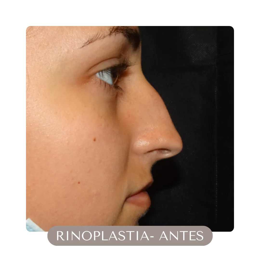 RINOPLASTIA ANTES RINOPLASTIA ANTES