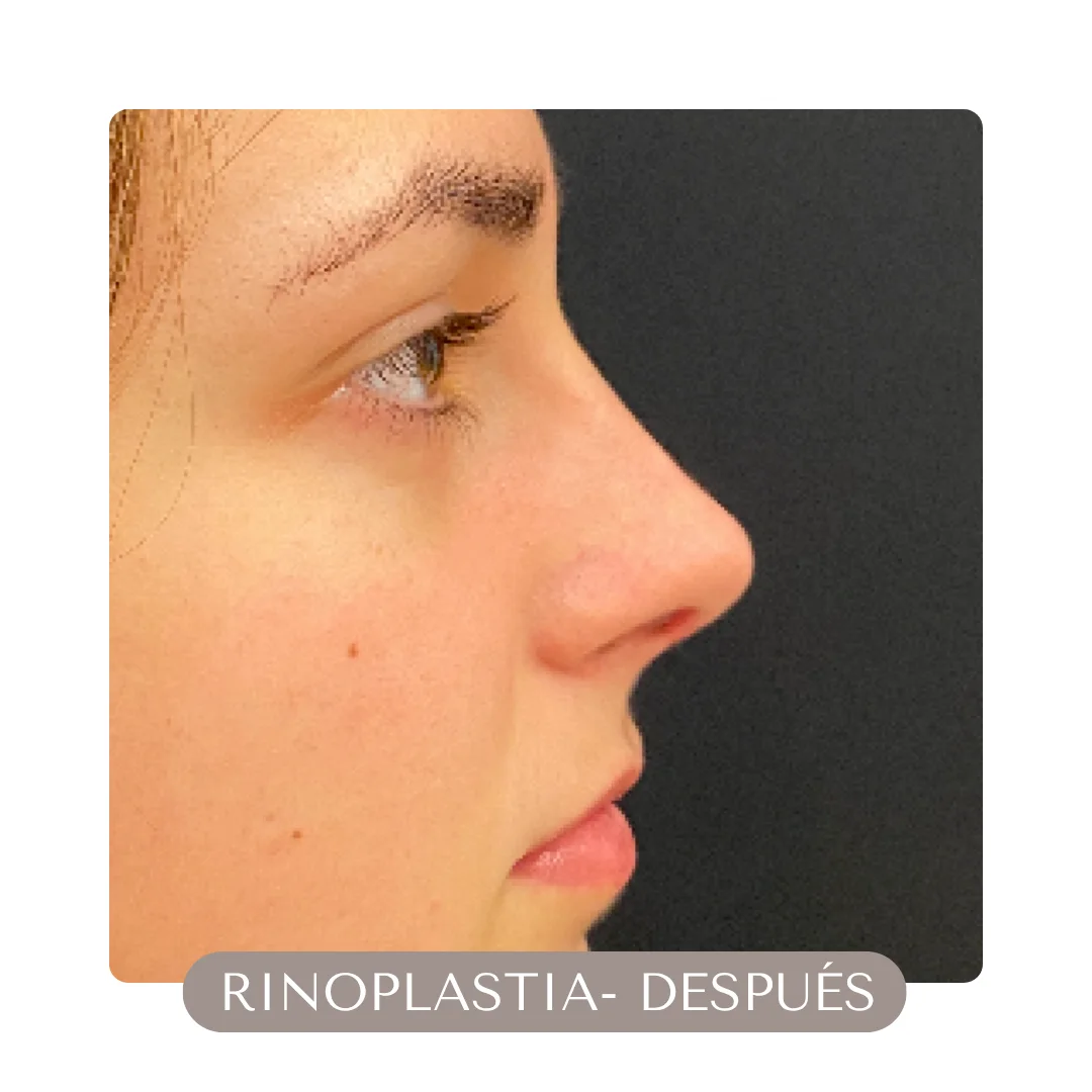 RINOPLASTIA DESPUES RINOPLASTIA DESPUES