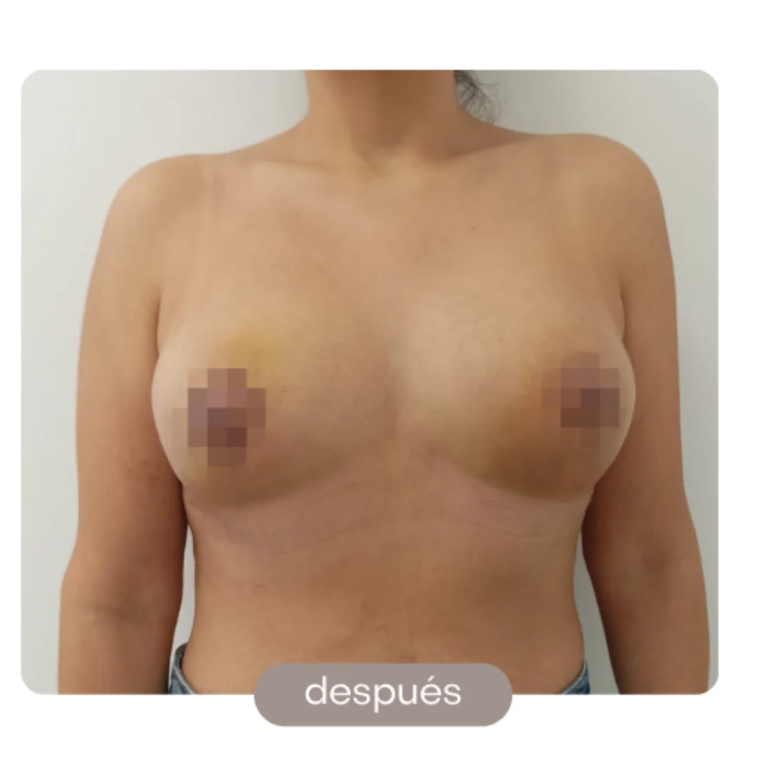 reduccion pecho reduccion pecho