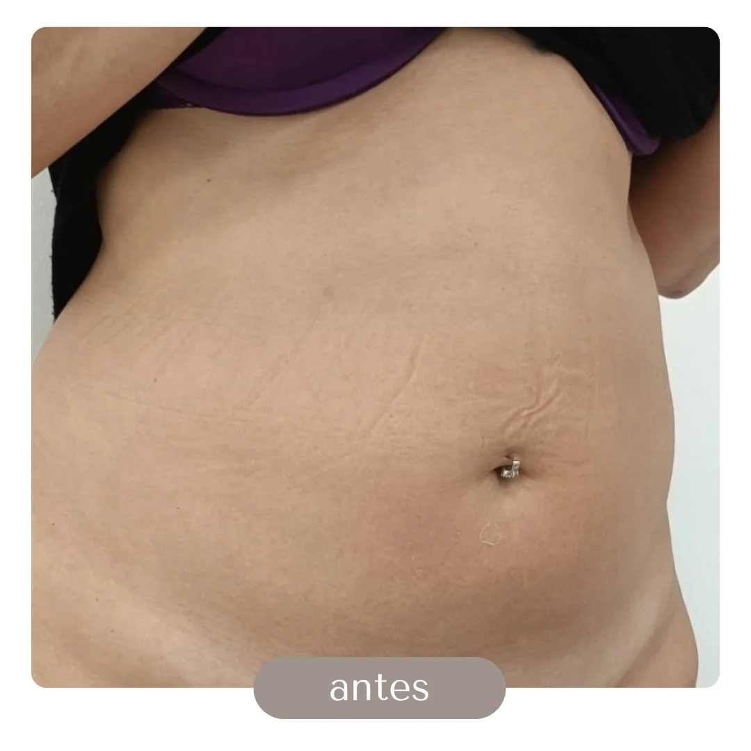 liposuccion con transferencia a gluteos