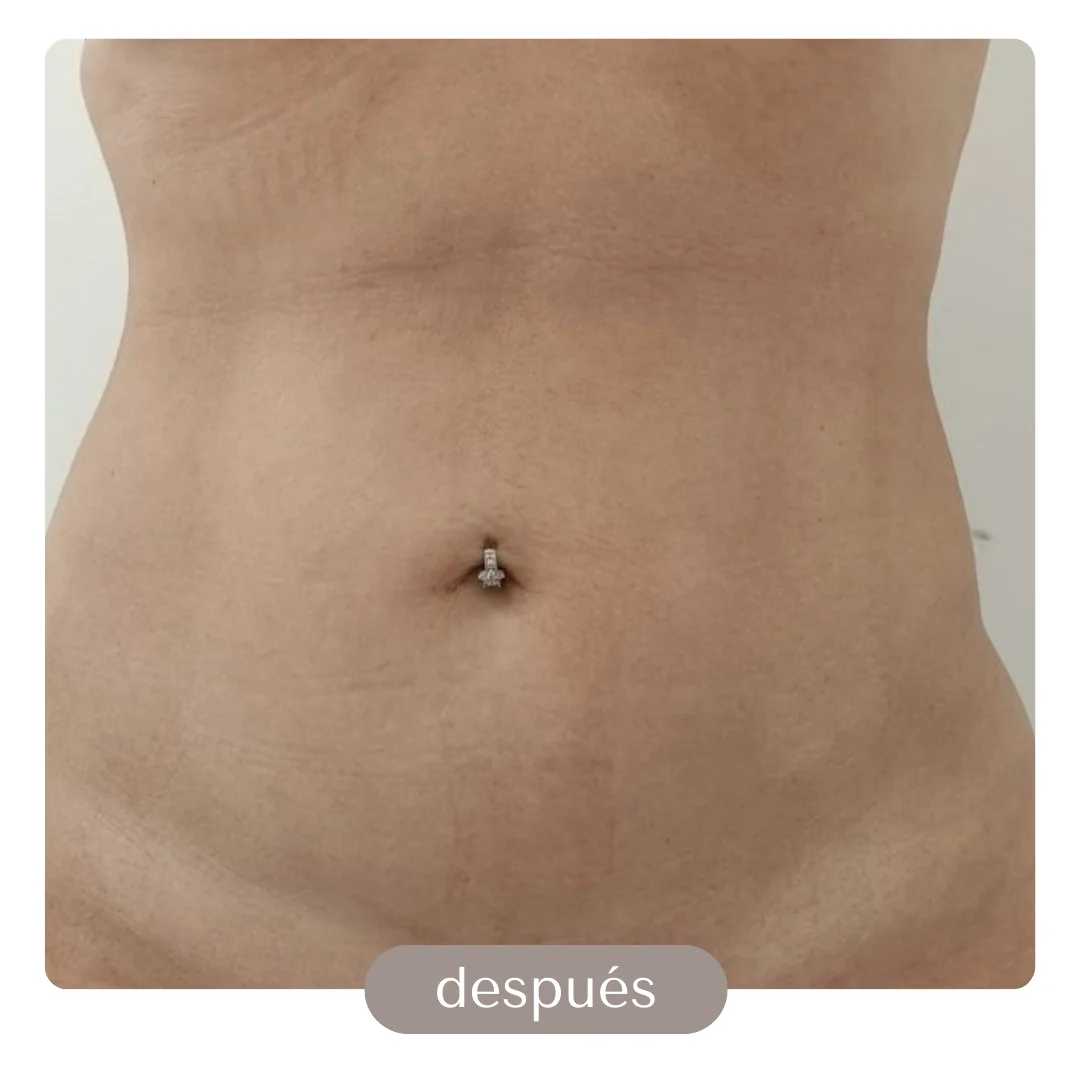 liposuccion con transferencia a gluteos
