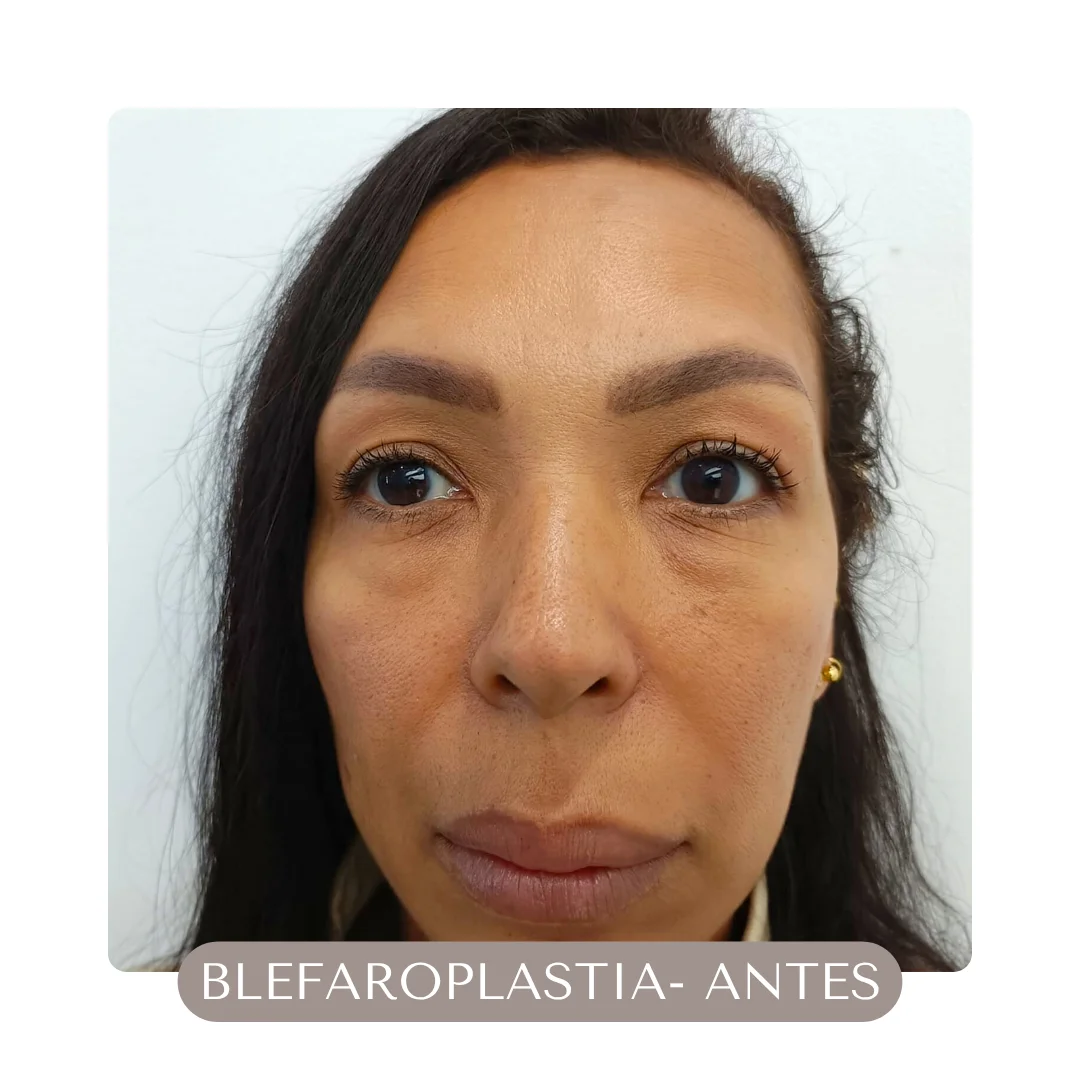 BLEFAROPLASTIA CASOS