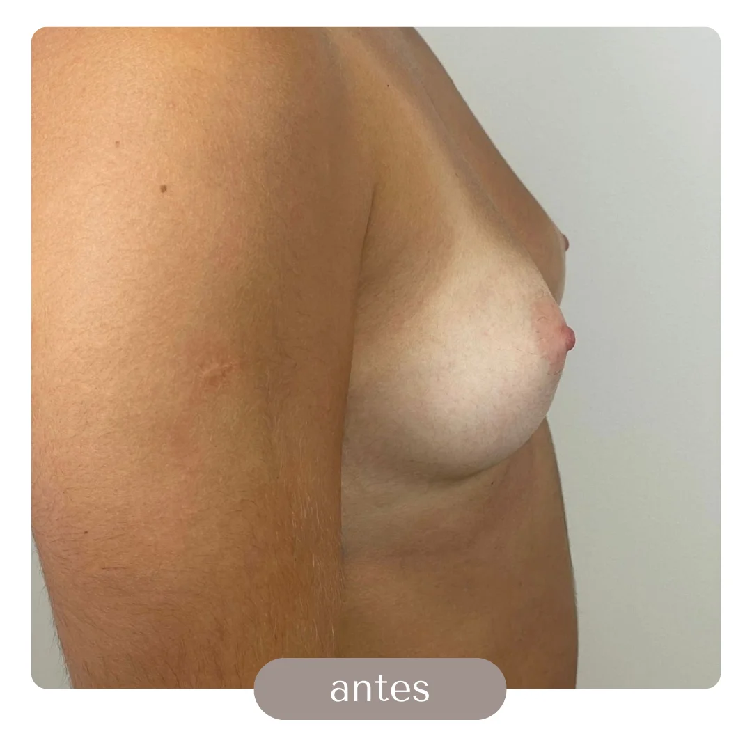 liposuccion con transferencia a gluteos