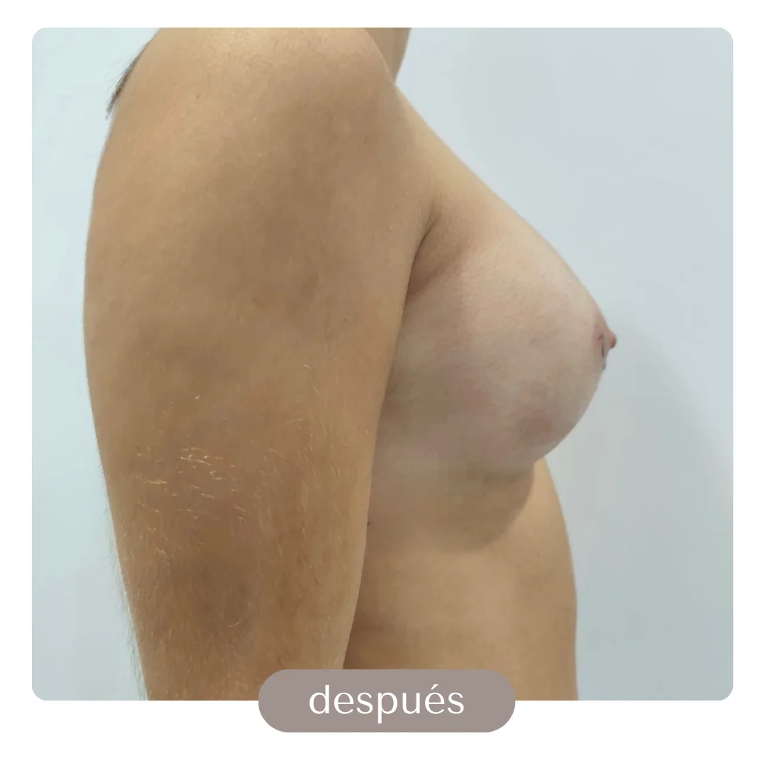 liposuccion con transferencia a gluteos