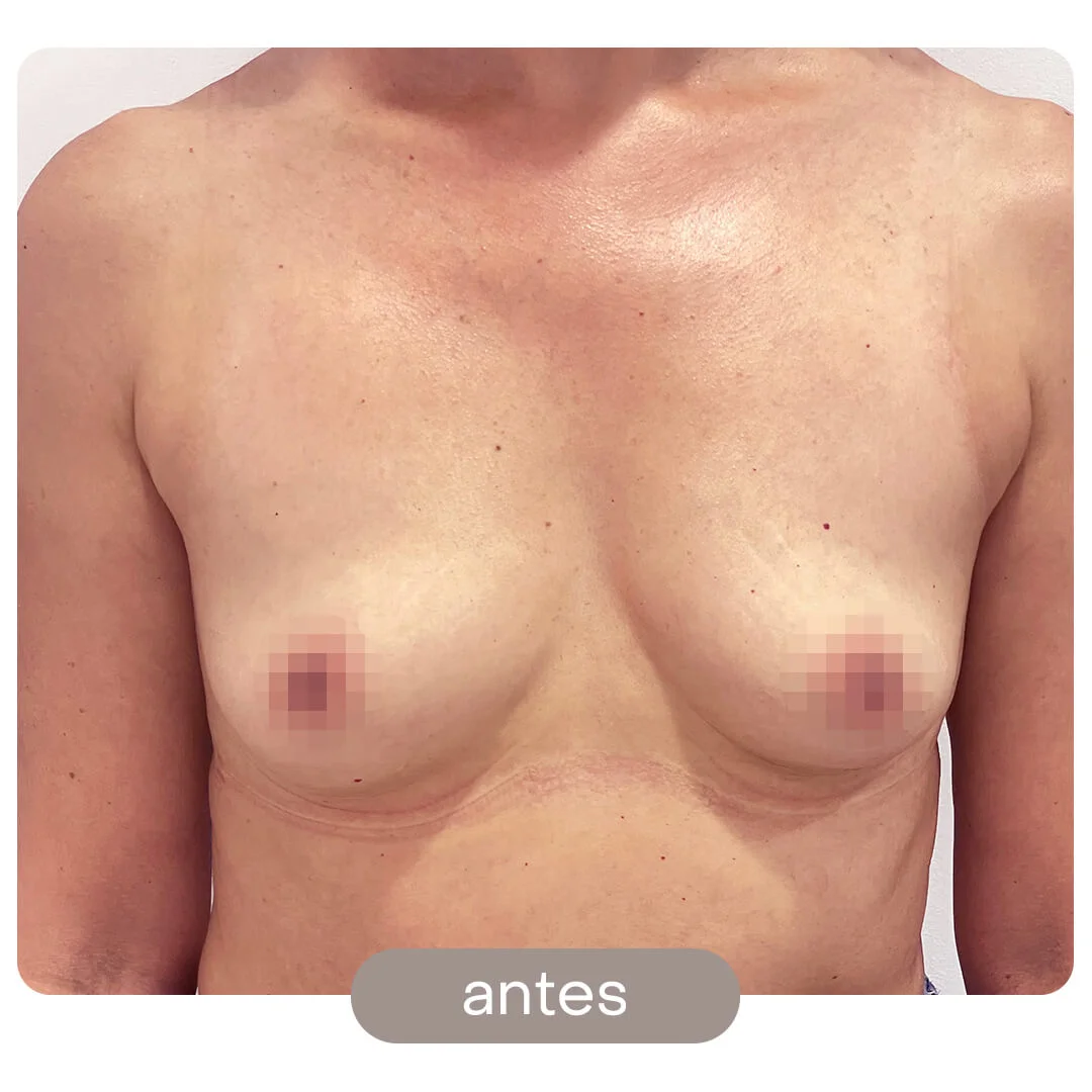 aumento pecho antes-despues