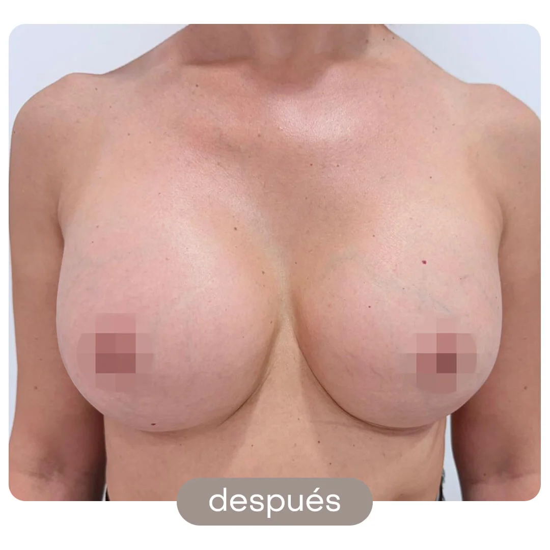aumento pecho antes-despues