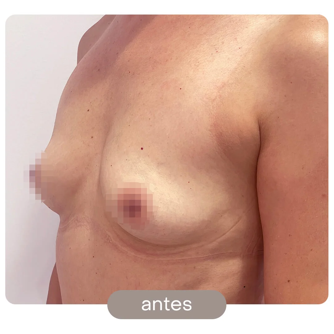 aumento pecho antes-despues