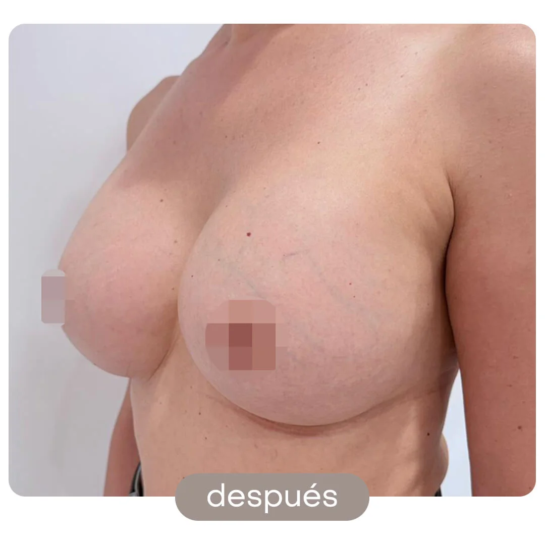 aumento pecho antes-despues