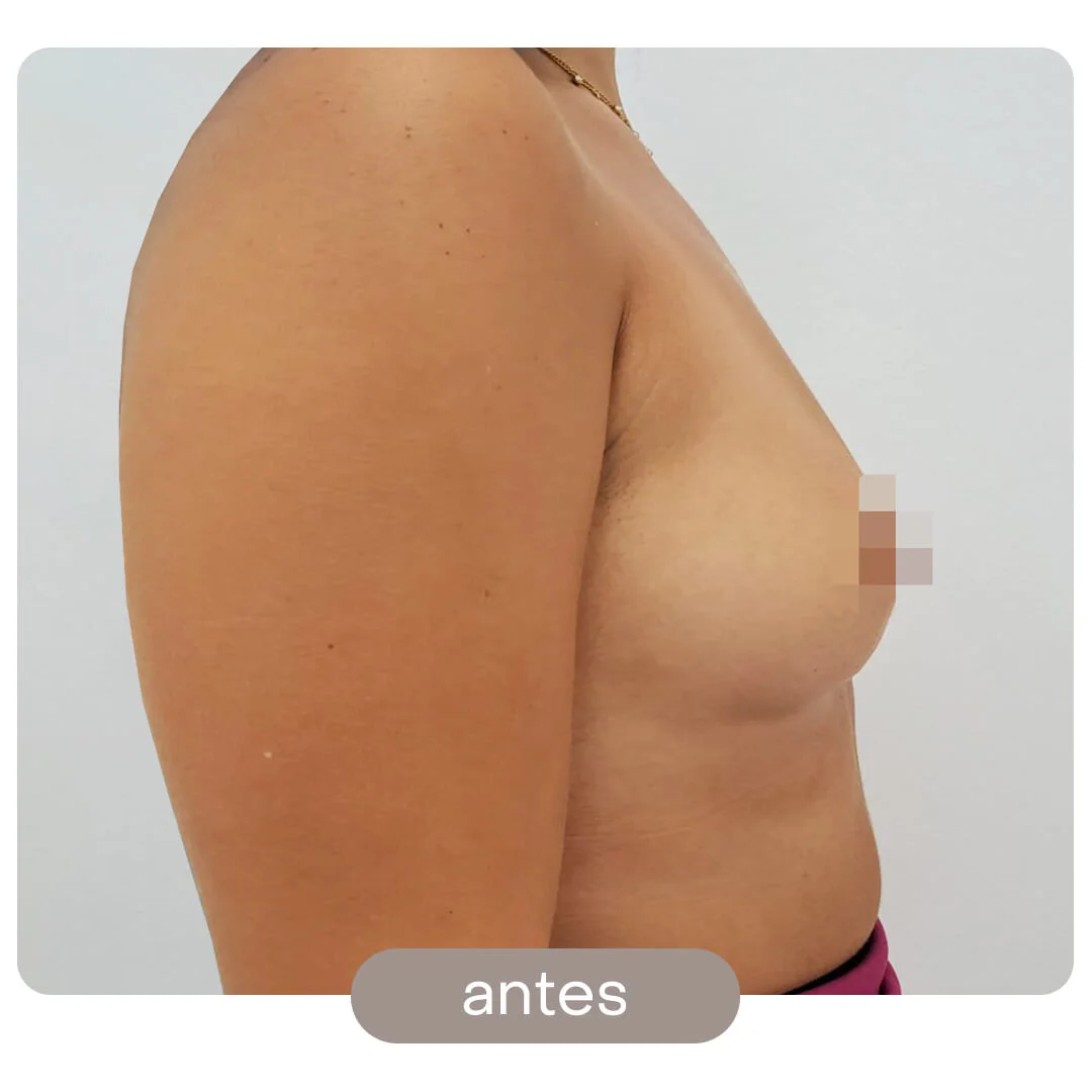 aumento pecho antes-despues