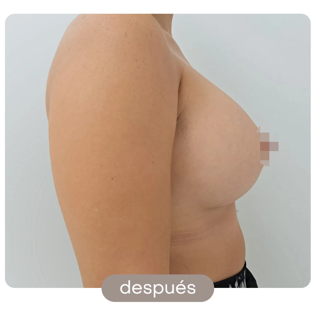 aumento pecho antes-despues