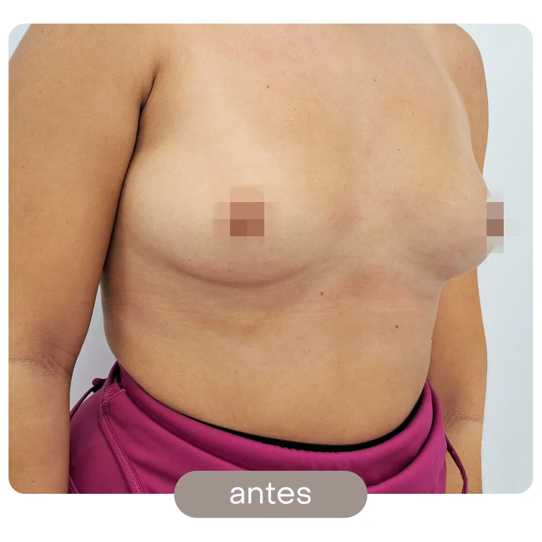 aumento pecho antes-despues