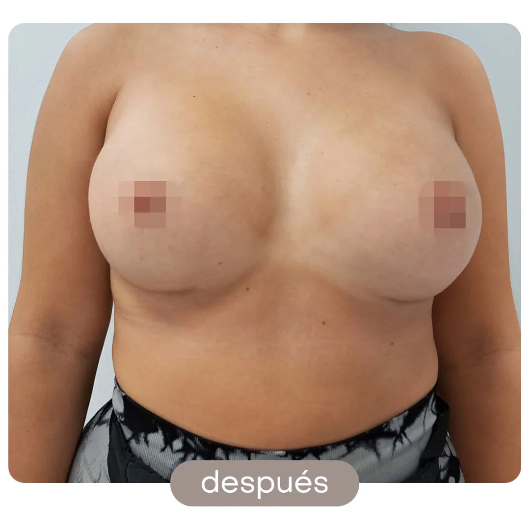 aumento pecho antes-despues